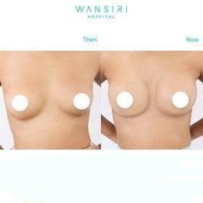 Résultats avant et après augmentation mammaire à Wansiri Hospital, forme améliorée