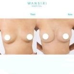 Résultats avant et après augmentation mammaire à Wansiri Hospital, forme améliorée