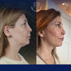 Vorher-nachher-Ergebnis Brauenlifting bei Dr. Safa Manav Clinic, sichtbare Verjüngung