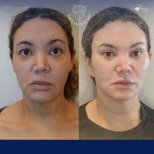 Vorher-nachher-Ergebnis Brauenlifting bei Dr. Safa Manav Clinic, sichtbare Stirnstraffung
