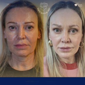 Vorher-nachher-Ergebnis Brauenlifting bei Dr. Safa Manav Clinic, sichtbare Stirnverjüngung