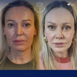 Vorher-nachher-Ergebnis Brauenlifting bei Dr. Safa Manav Clinic, sichtbare Stirnverjüngung