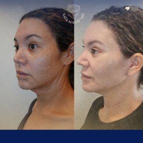 Vorher-nachher-Ergebnis Brauenlifting bei Dr. Safa Manav Clinic, sichtbare Verjüngung