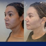 Vorher-nachher-Ergebnis Brauenlifting bei Dr. Safa Manav Clinic, sichtbare Verjüngung