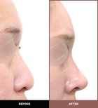 نتائج تجميل الأنف قبل وبعد في URBAN Plastic Surgery، تحسين شكل الأنف