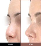 نتائج تجميل الأنف قبل وبعد في URBAN Plastic Surgery، تحسين شكل الأنف
