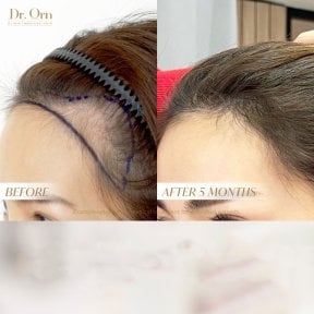 Результат пересадки волос у Dr.Orn Clinic: густіша лінія росту через 5 місяців
