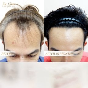 Результат пересадки волосся до і після 10 місяців у Dr.Orn Clinic : Medical Hair