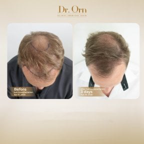 Результати до і після пересадки волосся в Dr.Orn Clinic : Medical Hair, покращена густота
