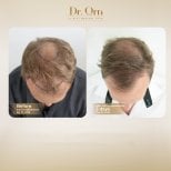 Результати до і після пересадки волосся в Dr.Orn Clinic : Medical Hair, покращена густота