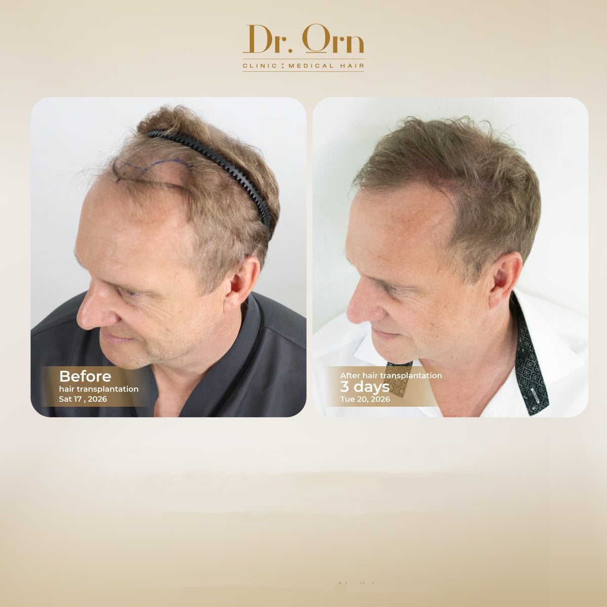 Resultados antes y después de trasplante capilar en Dr.Orn Clinic : Medical Hair, línea mejorada