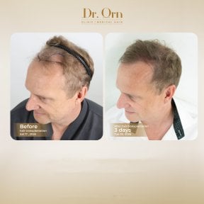 Результати до і після пересадки волосся в Dr.Orn Clinic : Medical Hair, покращена лінія