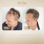 Результати до і після пересадки волосся в Dr.Orn Clinic : Medical Hair, покращена лінія