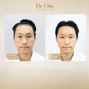 Результати до і після пересадки волосся в Dr.Orn Clinic : Medical Hair, покращена лінія