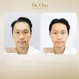 Результати до і після пересадки волосся в Dr.Orn Clinic : Medical Hair, покращена лінія
