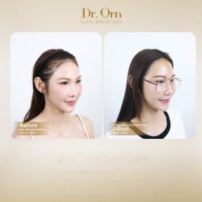Результати до і після пересадки волосся в Dr.Orn Clinic : Medical Hair, покращена лінія волосся