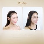 Результати до і після пересадки волосся в Dr.Orn Clinic : Medical Hair, покращена лінія волосся
