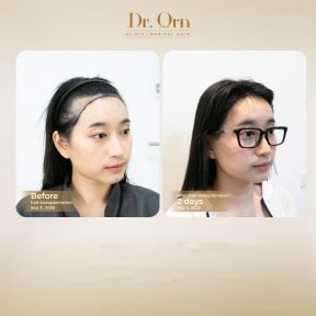 Результати до і після пересадки волосся в Dr.Orn Clinic : Medical Hair, покращена лінія росту