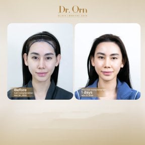 Результати до і після пересадки волосся в Dr.Orn Clinic : Medical Hair, покращена лінія