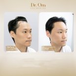 Результати до і після пересадки волосся в Dr.Orn Clinic : Medical Hair, покращена лінія
