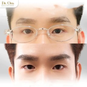 Результати пересадки брів до і після в Dr.Orn Clinic : Medical Hair, густі брови