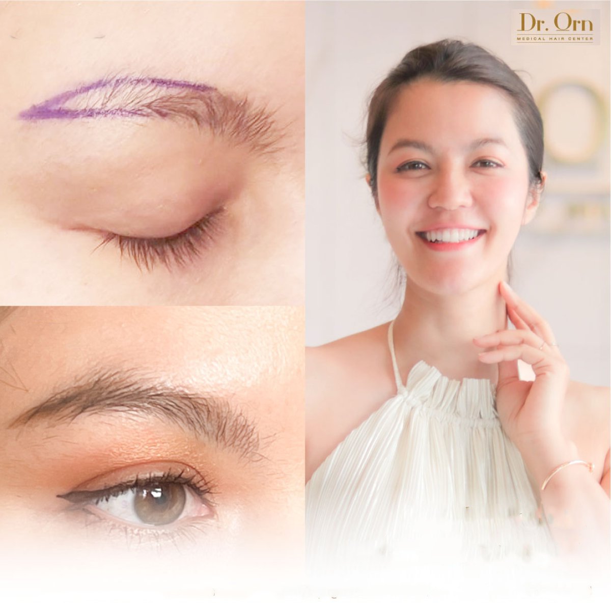 Resultados de trasplante de cejas antes y después en Dr.Orn Clinic : Medical Hair, cejas más densas