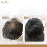 Результати пересадки волосся в Dr.Orn Clinic: підвищена густота волосся на шкірі голови