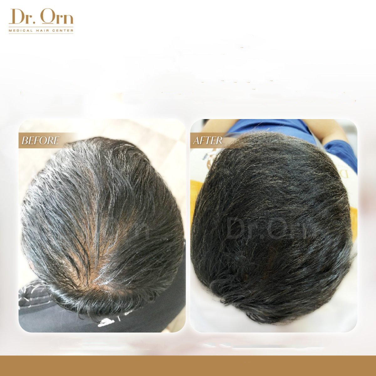 نتائج قبل وبعد زراعة الشعر في Dr.Orn Clinic : Medical Hair، كثافة شعر محسنة