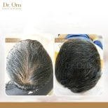 Результати до та після пересадки волосся в Dr.Orn Clinic : Medical Hair, густота волосся