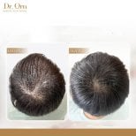 Результати пересадки волосся до і після в Dr.Orn Clinic: покращена густота на тімені