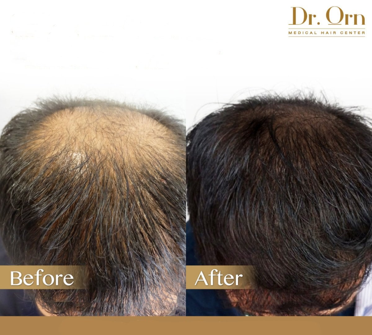 نتيجة قبل وبعد زراعة الشعر في Dr.Orn Clinic : Medical Hair، كثافة شعر مستعادة