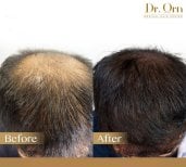 Результат до та після пересадки волосся в Dr.Orn Clinic : Medical Hair, відновлена густота