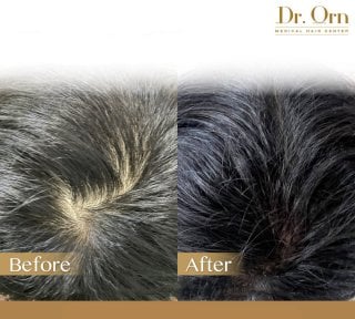 Результати пересадки волосся до і після в Dr.Orn Clinic : Medical Hair, покращена густота