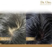Результати пересадки волосся до і після в Dr.Orn Clinic : Medical Hair, покращена густота