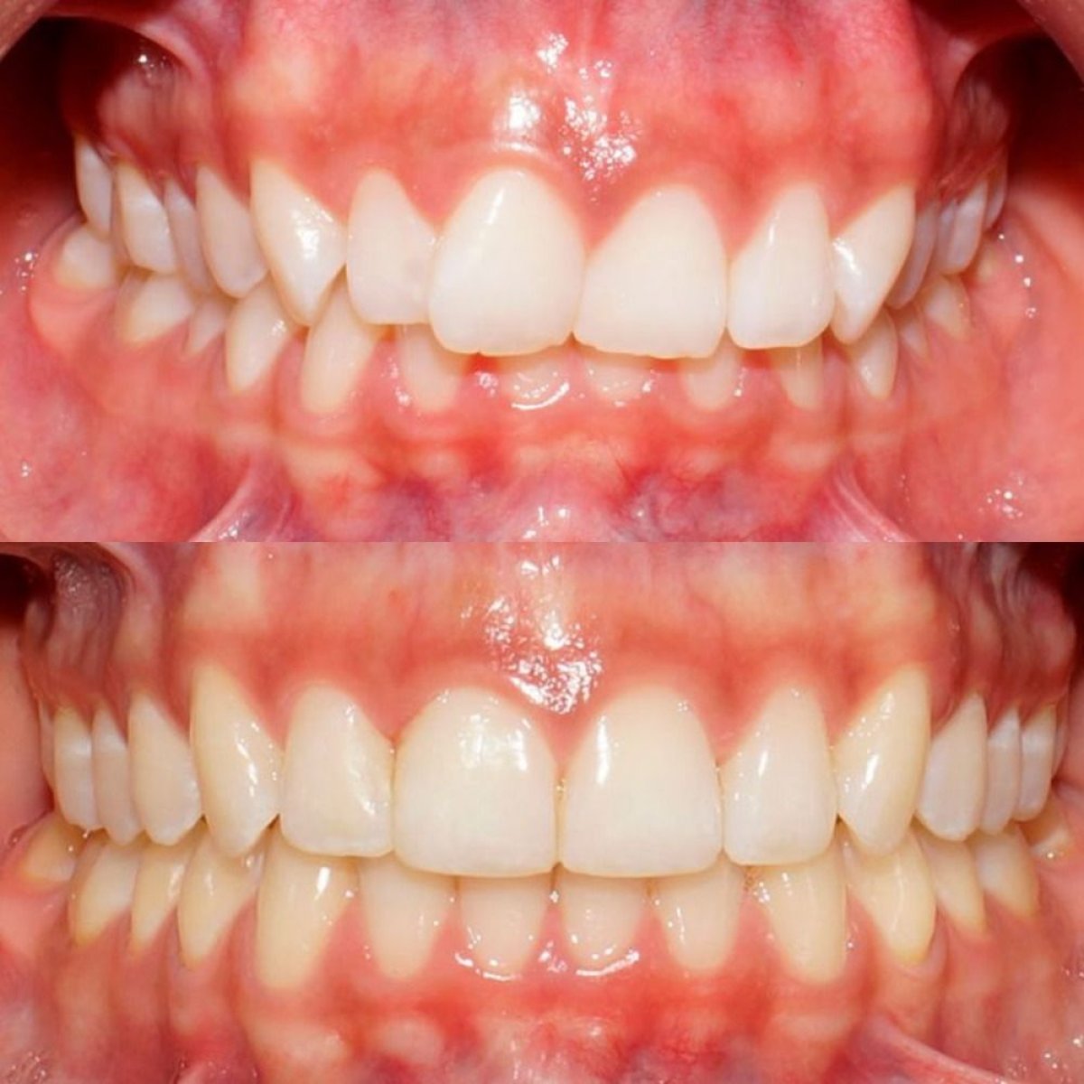 Antes y después de carillas dentales en Ortodoncia CDMX, mejora de alineación y estética dental