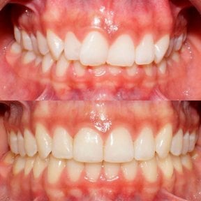Before and after dental veneers at Ortodoncia CDMX, improved smile alignment and aesthetics