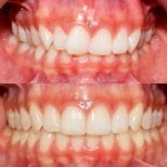 Before and after dental veneers at Ortodoncia CDMX, improved smile alignment and aesthetics