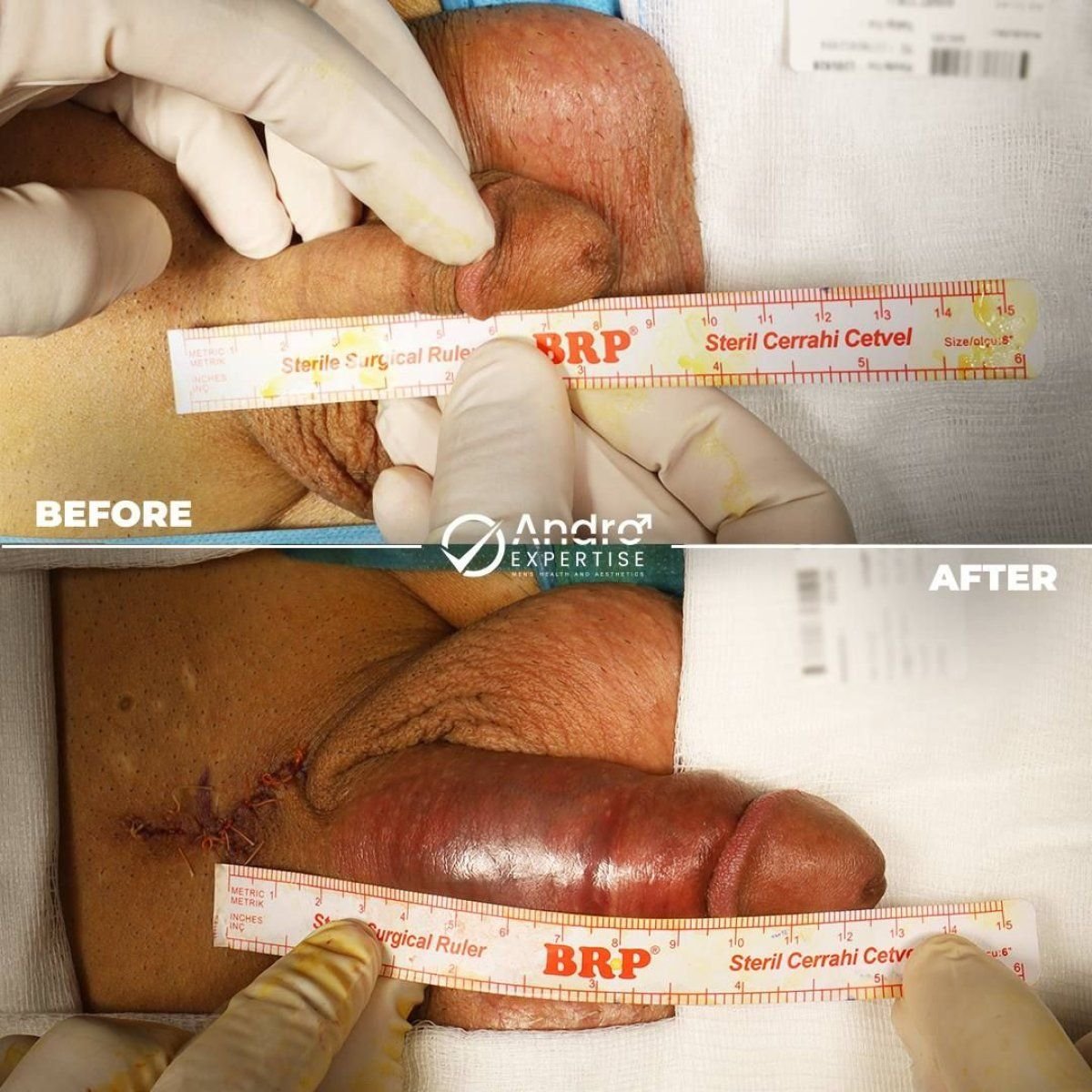 نتائج قبل وبعد زراعة القضيب في Andro Expertise Men's Health and Aesthetics