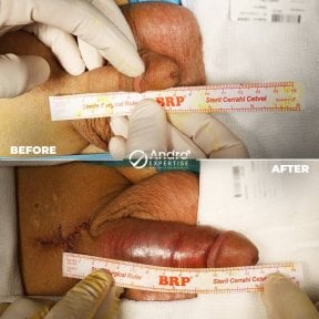 Before and after penile implant surgery results at Andro Expertise Men's Health and Aesthetics