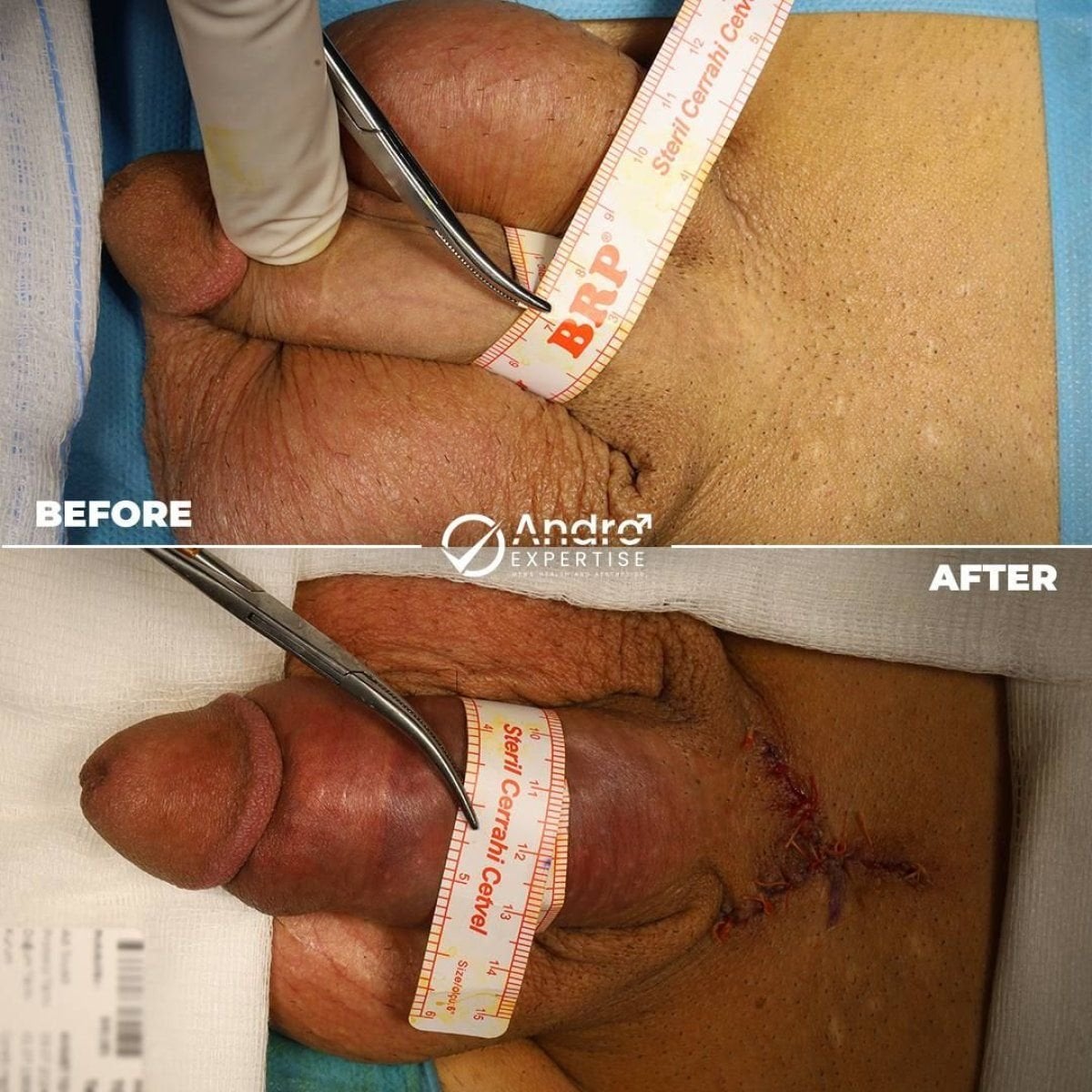 نتائج قبل وبعد زراعة دعامة القضيب في Andro Expertise Men's Health and Aesthetics