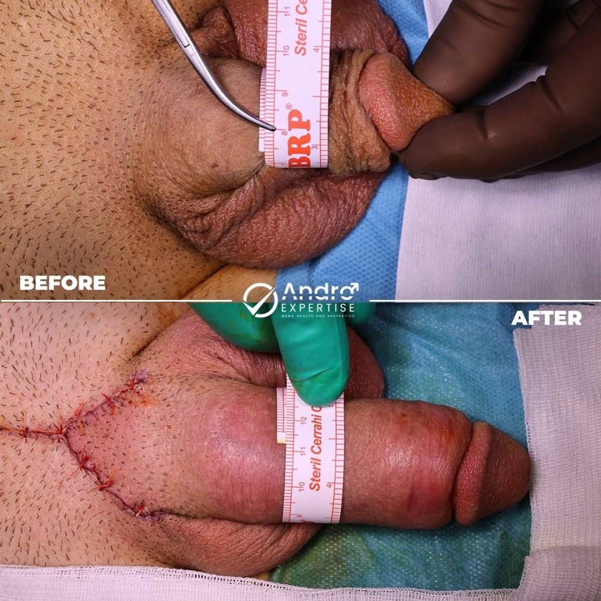 نتائج قبل وبعد زراعة القضيب في Andro Expertise Men's Health and Aesthetics
