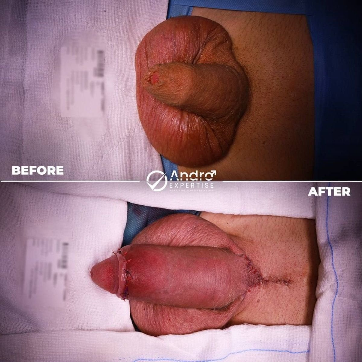 Resultados antes y después de implante de pene en Andro Expertise Men's Health and Aesthetics