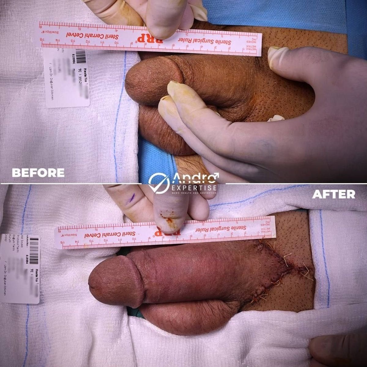نتائج قبل وبعد زراعة دعامة القضيب في Andro Expertise Men's Health and Aesthetics