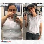 Before and after gastric bypass results at CE International Hospital, significant weight loss shown