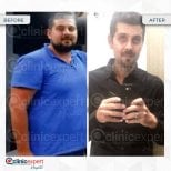 Before and after gastric bypass results at CE International Hospital, significant weight loss
