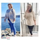 Before and after gastric bypass results at CE International Hospital, visible weight loss achieved