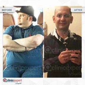 Before and after gastric bypass results at CE International Hospital, significant weight loss
