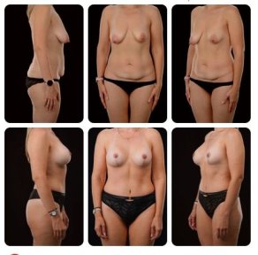 Before and after tummy tuck results at Yurchenko Plastic Surgery Team, improved abdomen contour