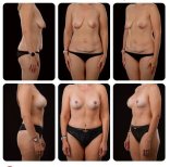 Before and after tummy tuck results at Yurchenko Plastic Surgery Team, improved abdomen contour