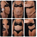 Before and after tummy tuck results at Yurchenko Plastic Surgery Team, visible body contouring